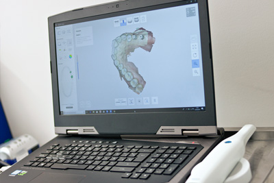 clínica dental en andoain: escaner intraoral
